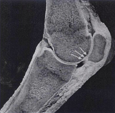 subchondral1-1.jpg